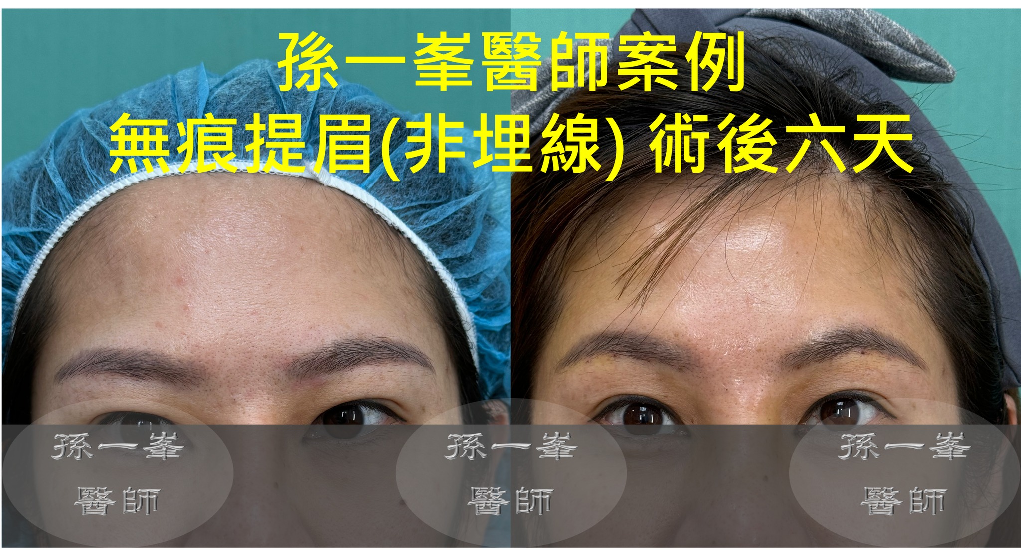 無痕提眉手術(二) - 非埋線